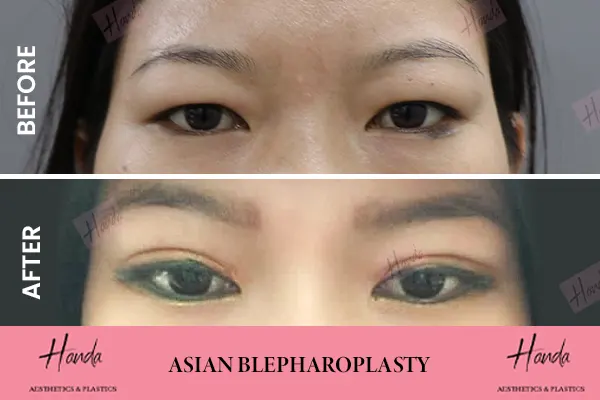 ASIAN BLEPHAROPLASTY before and after — Handa Aesthetics