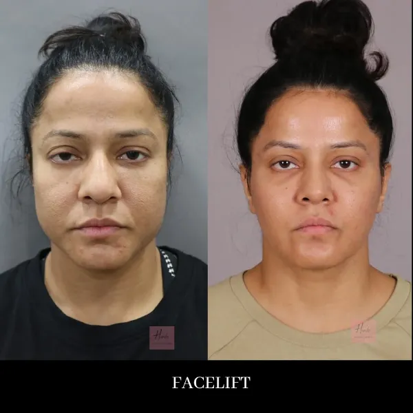 FACE LIFT before and after — Handa Aesthetics