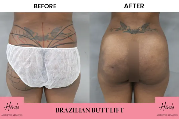 Butt Lift before and after — Handa Aesthetics