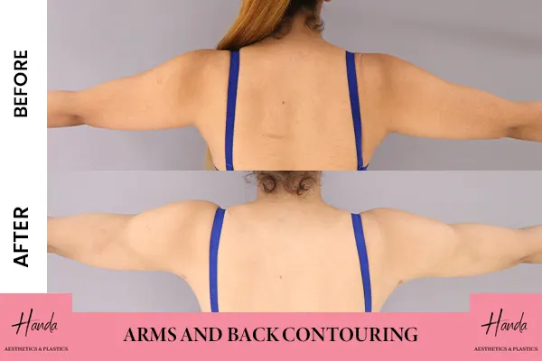 Arms & Thighs Lift before and after — Handa Aesthetics