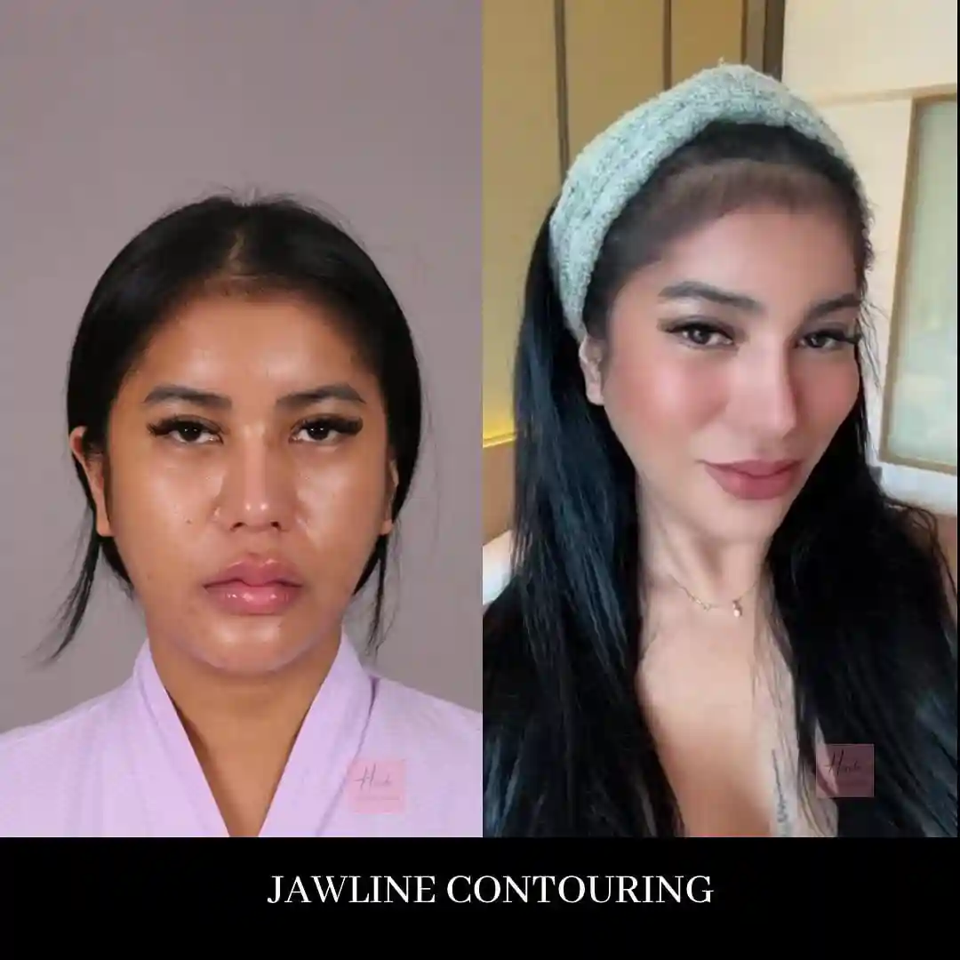 Face before and after — Handa Aesthetics