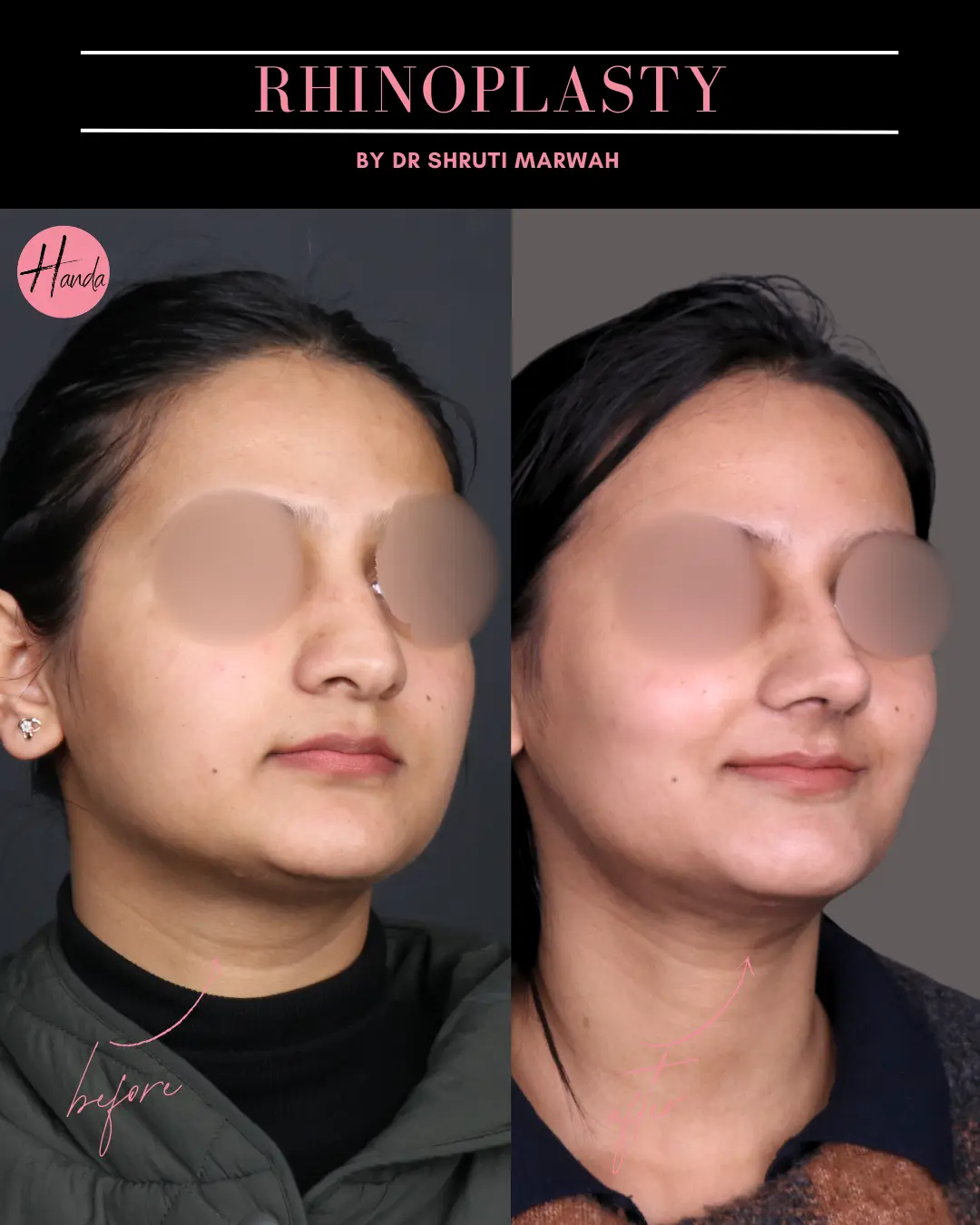 RHINOPLASTY before and after — Handa Aesthetics