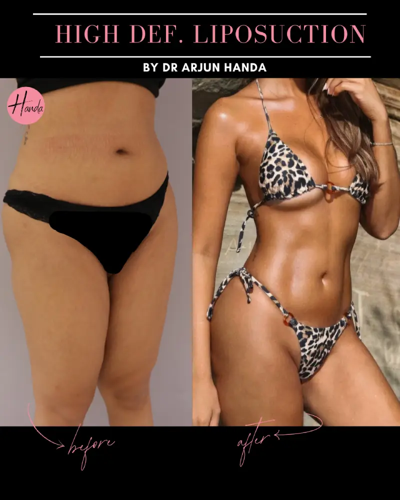 Liposuction before and after — Handa Aesthetics