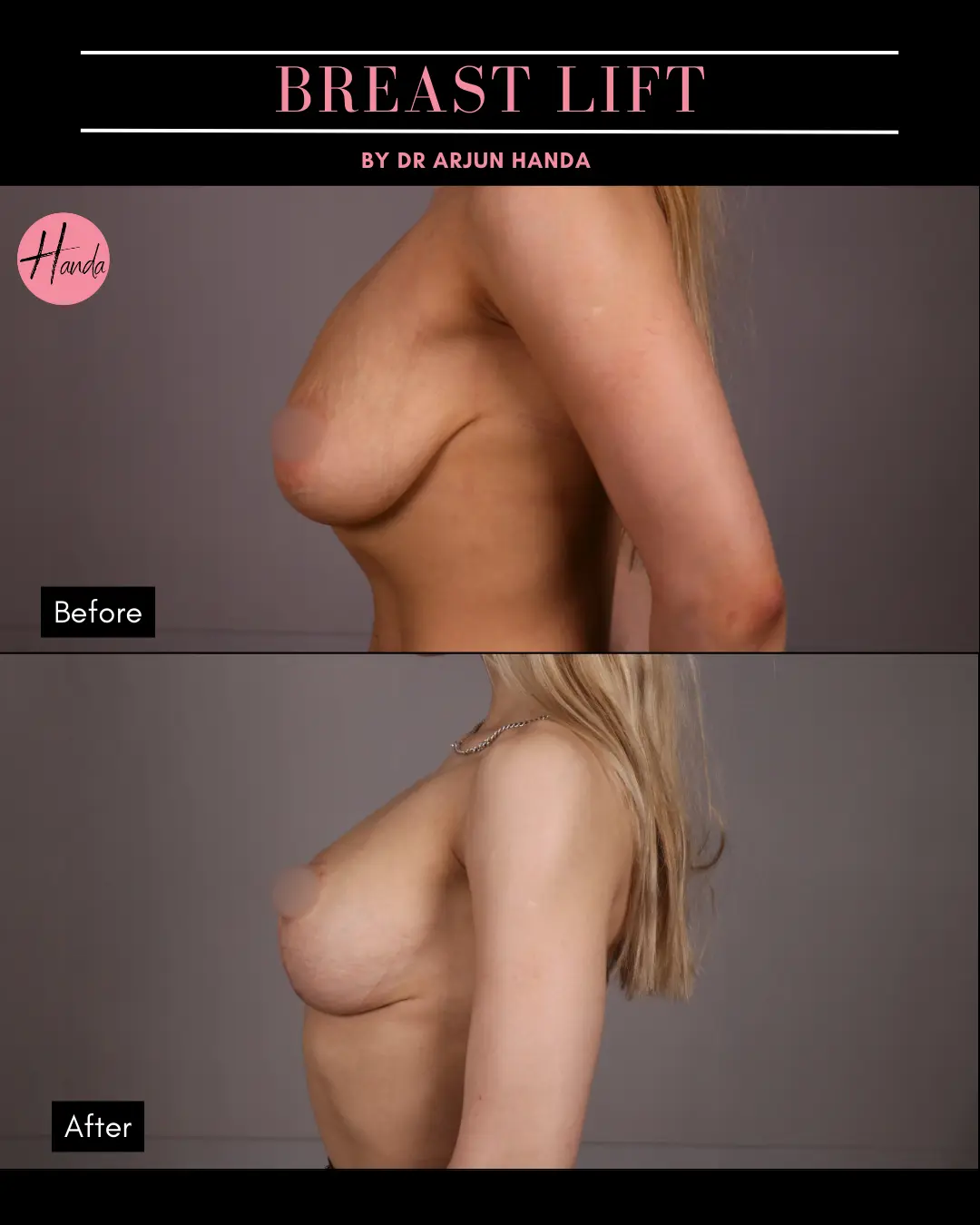 BREAST REDUCTION AND LIFT before and after — Handa Aesthetics