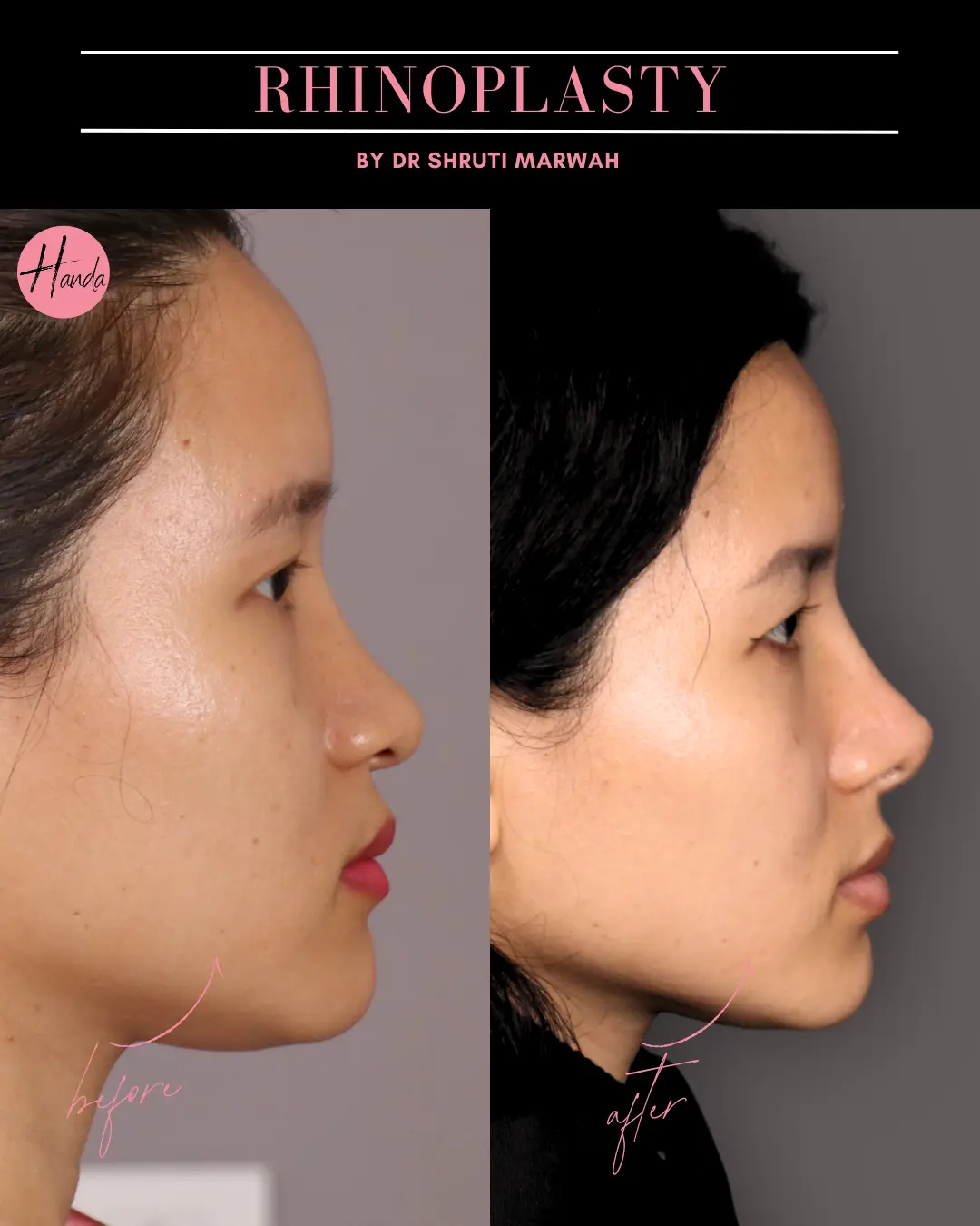 RHINOPLASTY before and after — Handa Aesthetics
