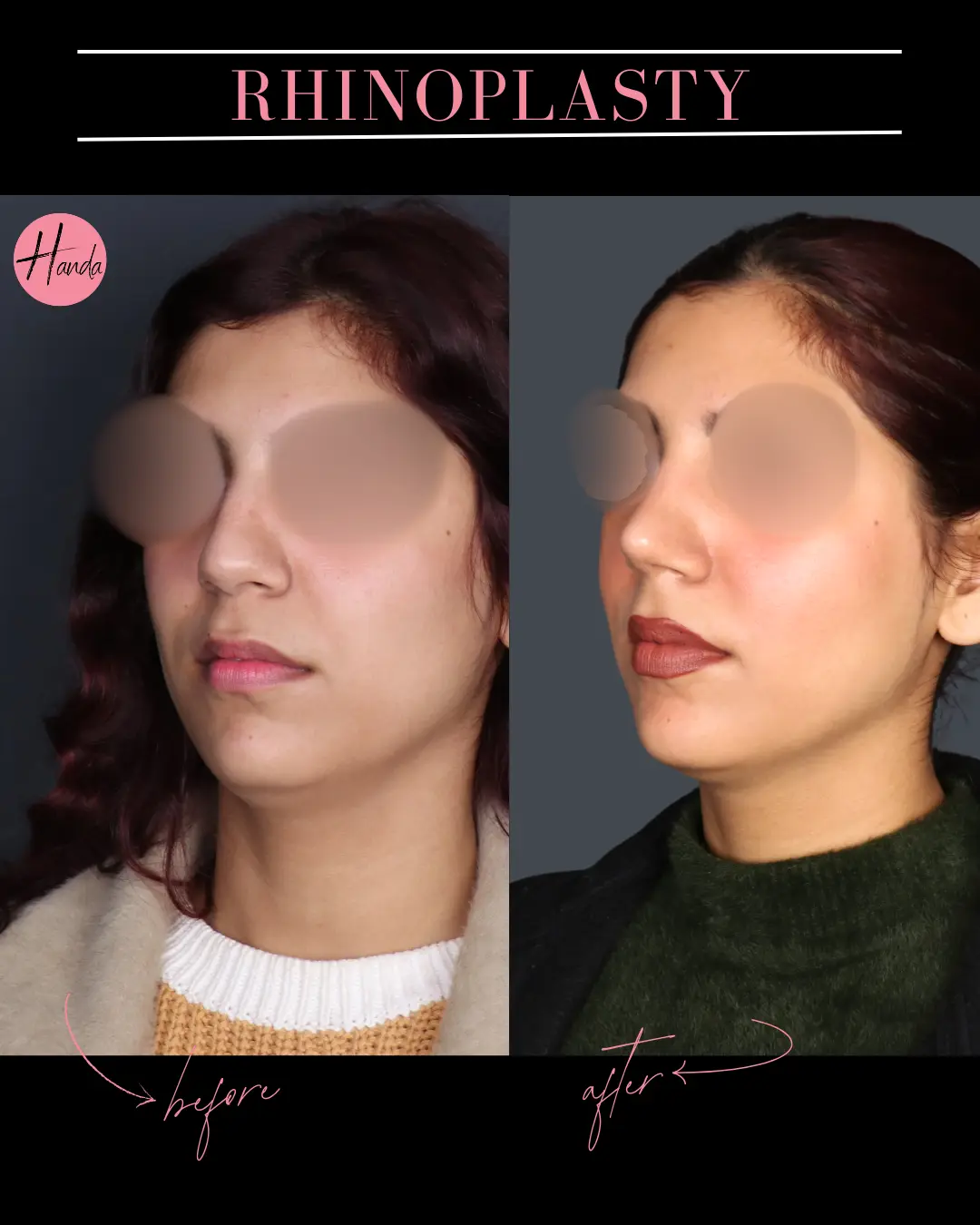 RHINOPLASTY before and after — Handa Aesthetics