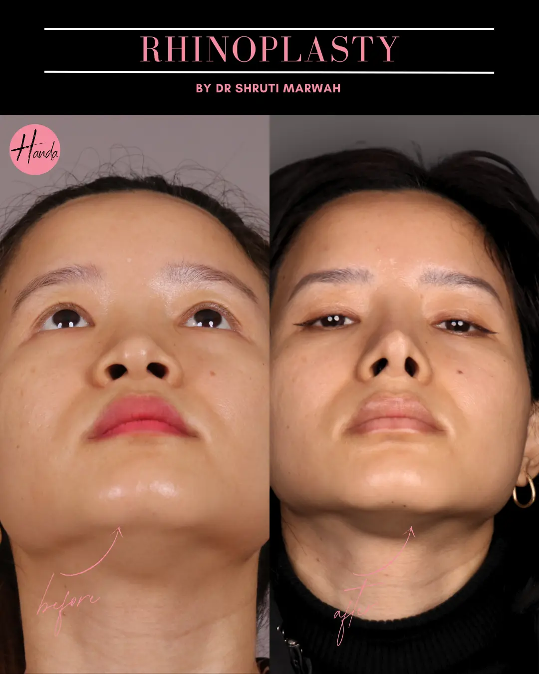 RHINOPLASTY before and after — Handa Aesthetics