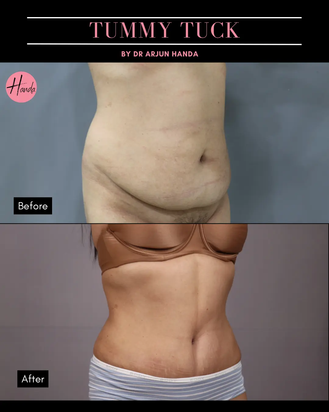 Tummy Tuck (Full Abdominoplasty) before and after — Handa Aesthetics