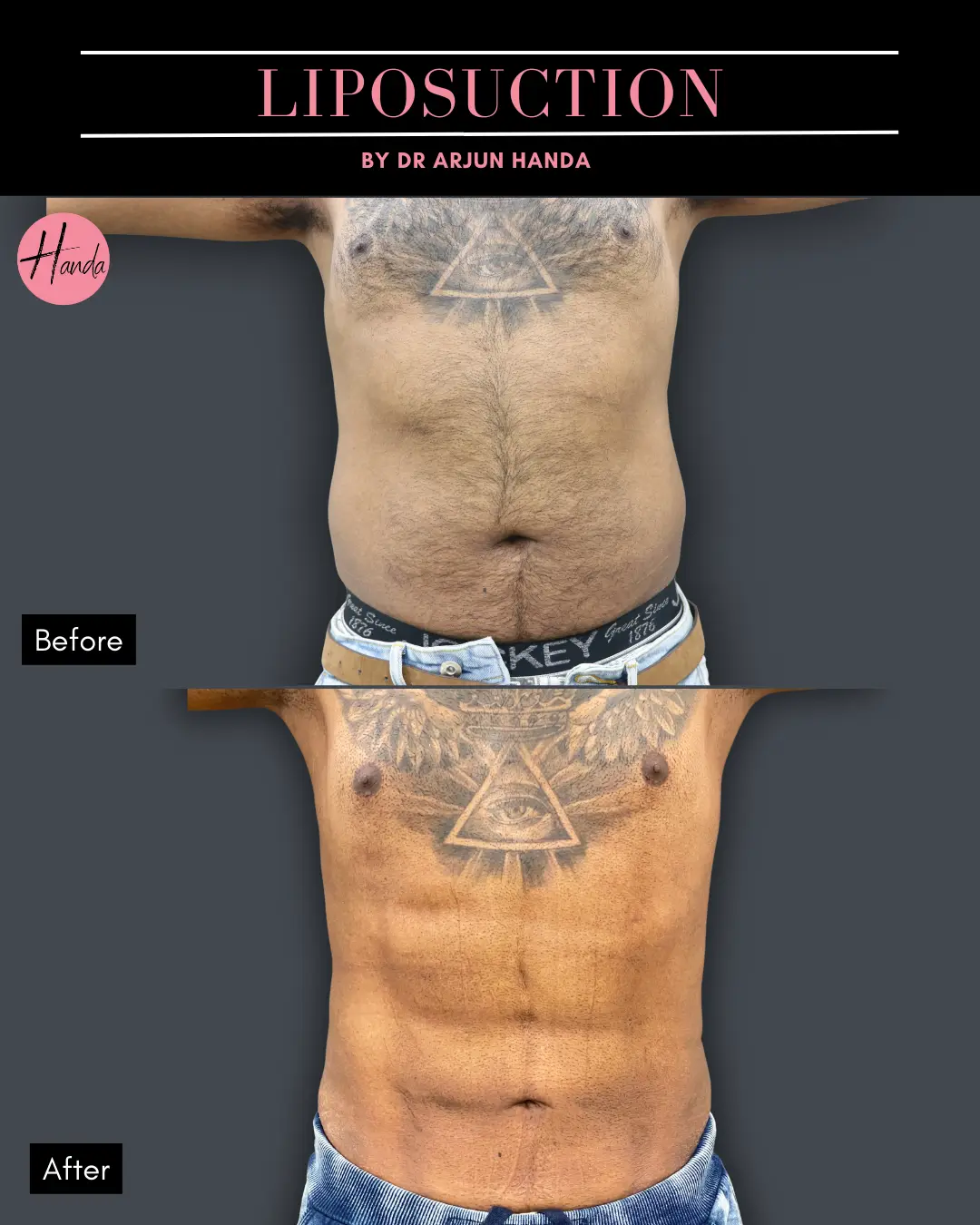 Liposuction before and after — Handa Aesthetics
