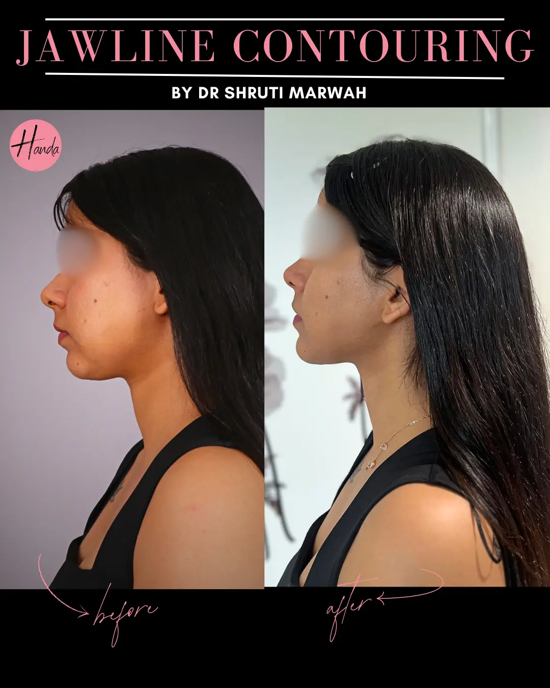 CHIN & JAWLINE LIPOSUCTION before and after — Handa Aesthetics