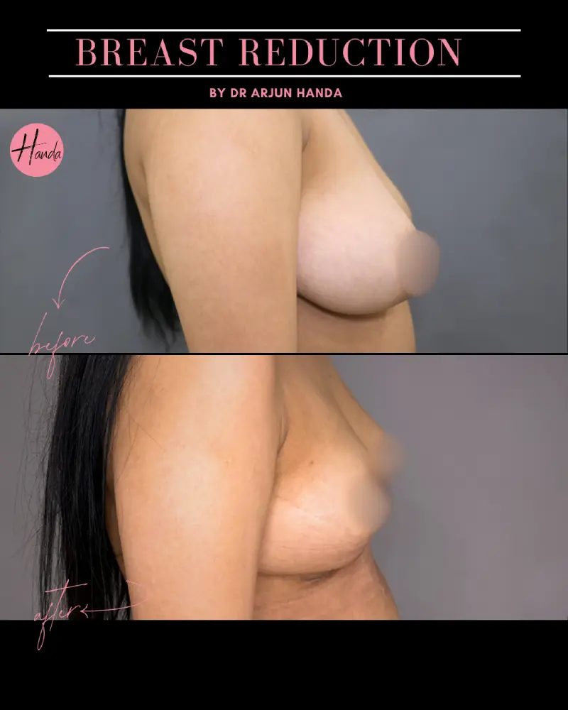 BREAST REDUCTION AND LIFT before and after — Handa Aesthetics