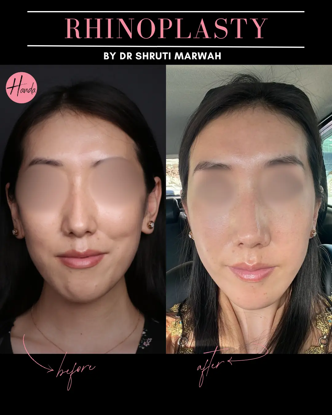 RHINOPLASTY before and after — Handa Aesthetics