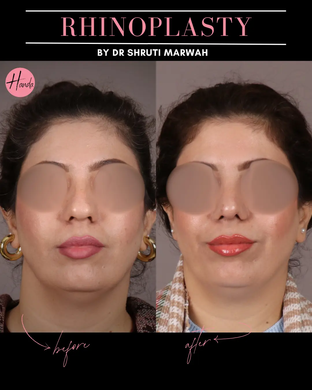 RHINOPLASTY before and after — Handa Aesthetics