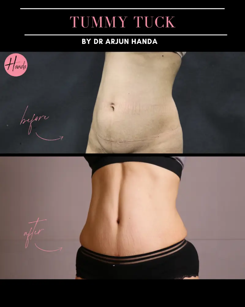 Tummy Tuck (Full Abdominoplasty) before and after — Handa Aesthetics