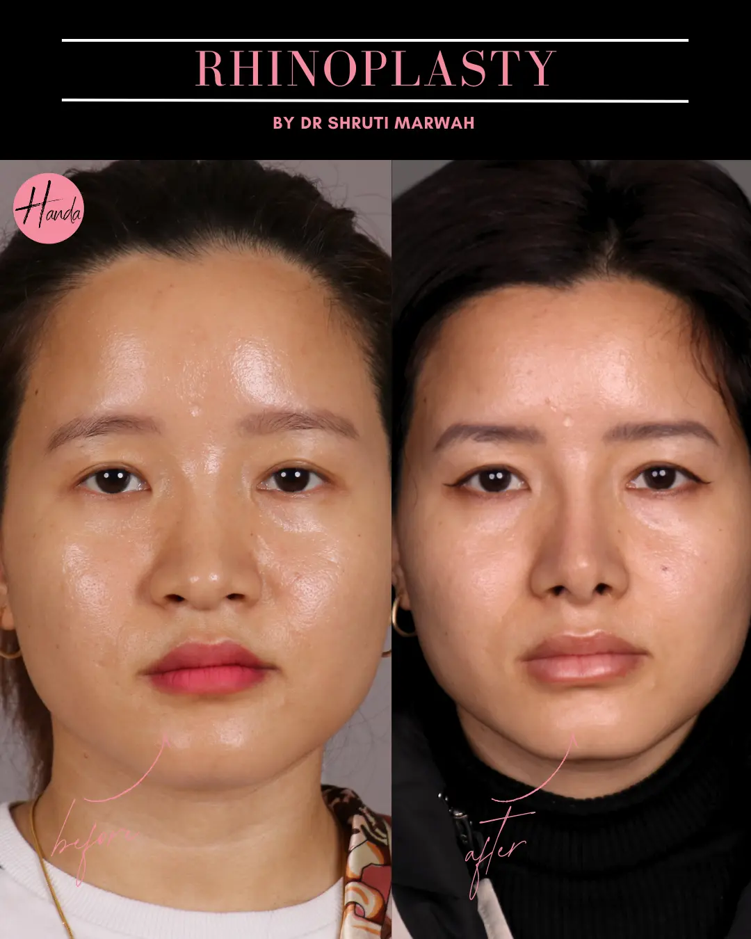 RHINOPLASTY before and after — Handa Aesthetics