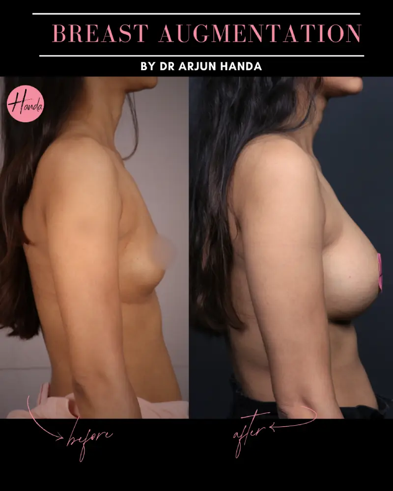 BREAST AUGMENTATION before and after — Handa Aesthetics