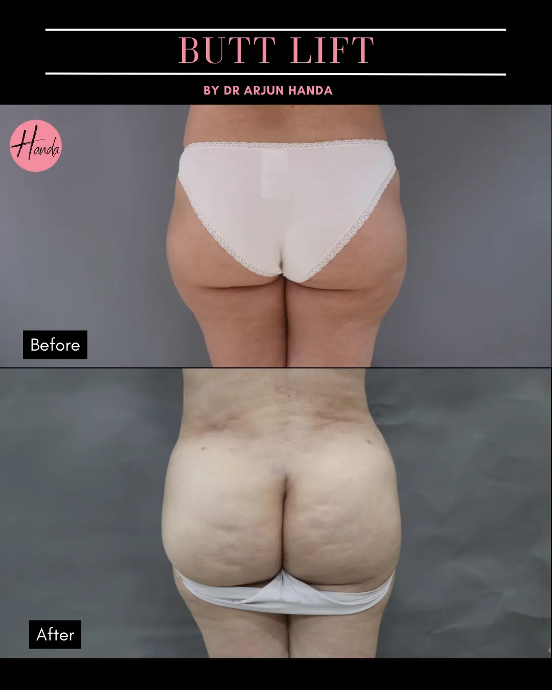 Butt Lift before and after — Handa Aesthetics