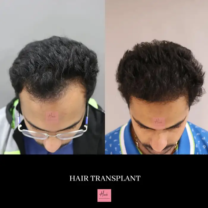 Hair Transplant before and after — Handa Aesthetics