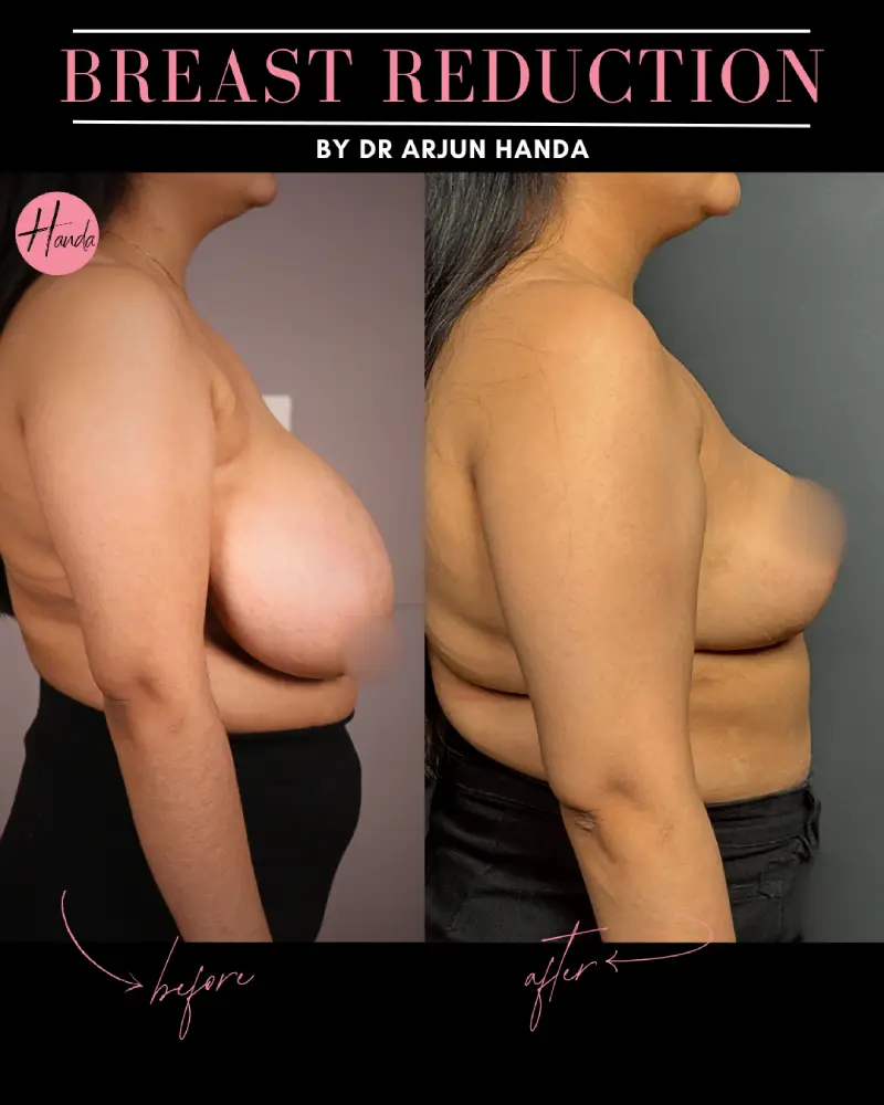 BREAST REDUCTION AND LIFT before and after — Handa Aesthetics
