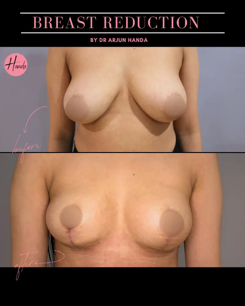 BREAST REDUCTION AND LIFT before and after — Handa Aesthetics