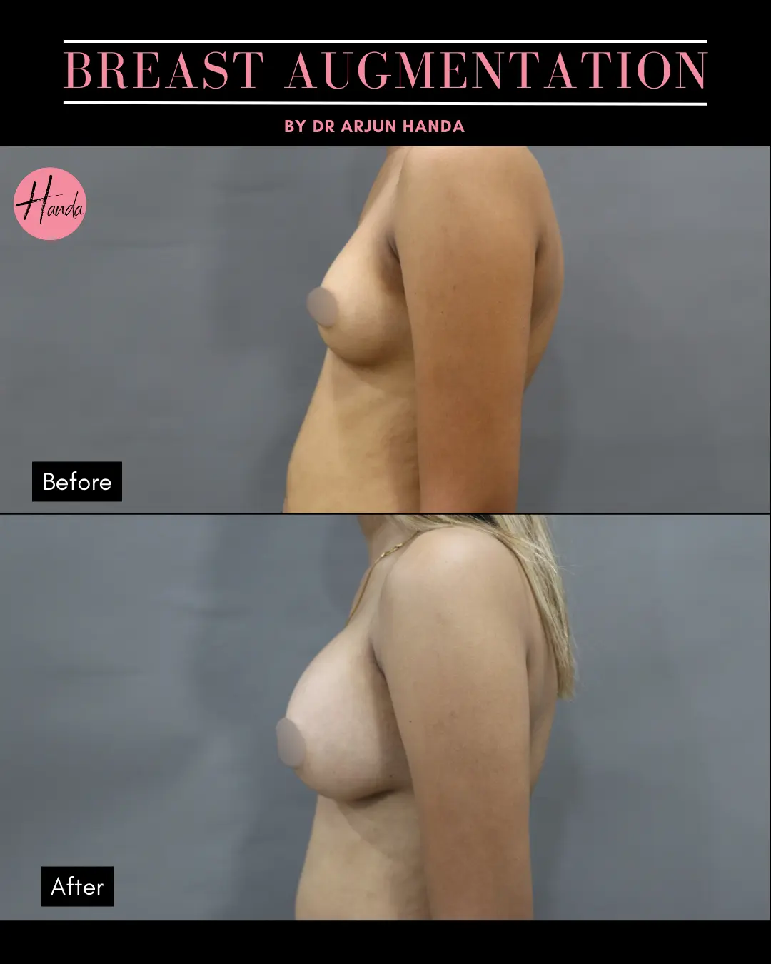 BREAST AUGMENTATION before and after — Handa Aesthetics