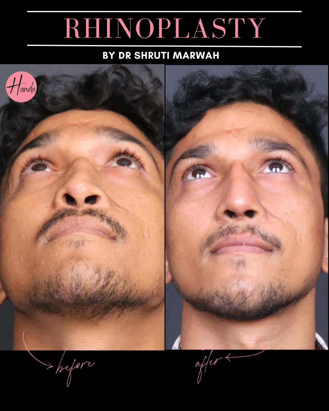RHINOPLASTY before and after — Handa Aesthetics