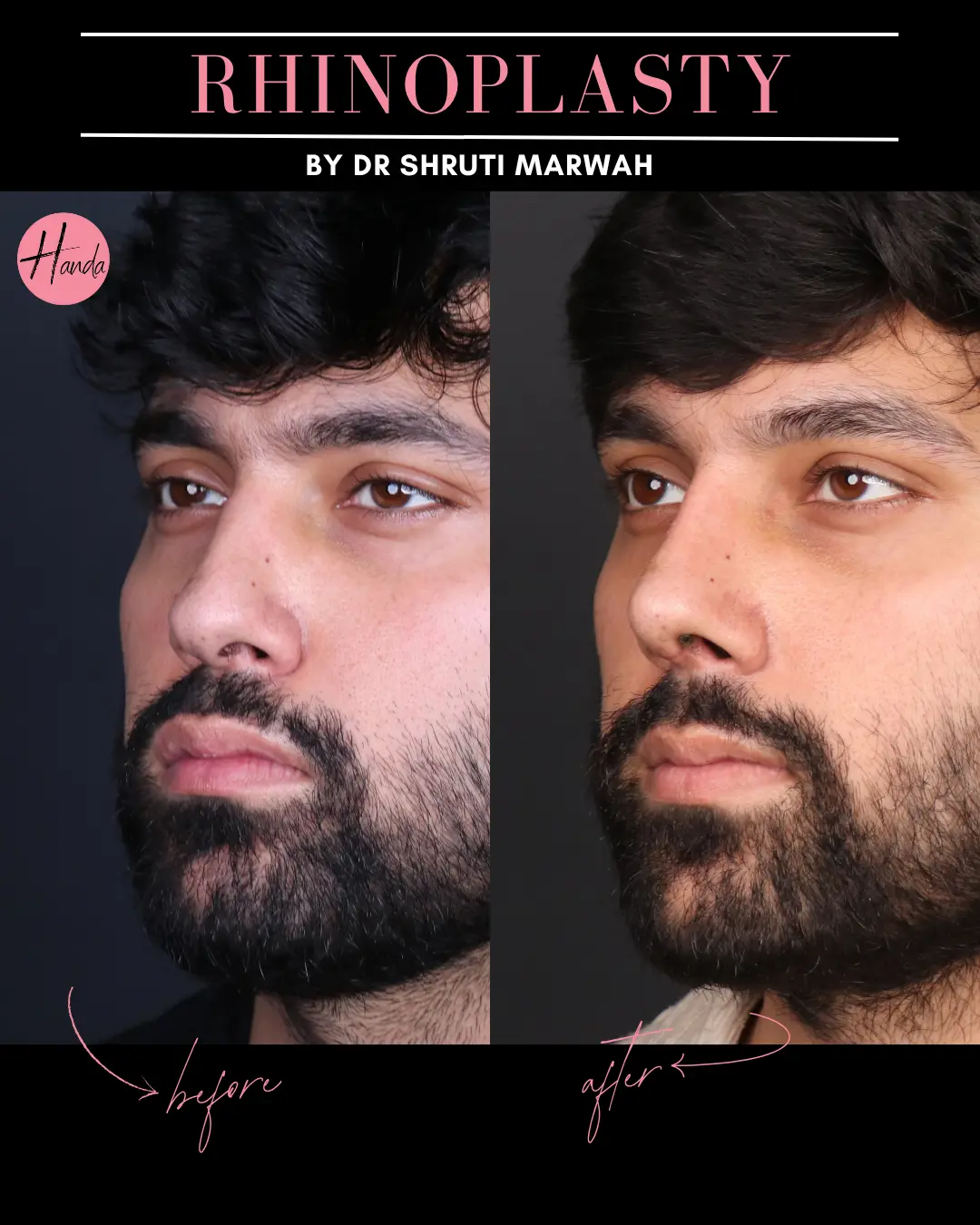 RHINOPLASTY before and after — Handa Aesthetics