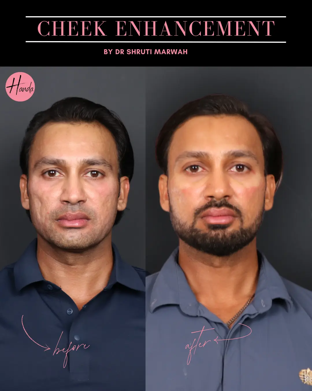 CHEEK ENHANCEMENT before and after — Handa Aesthetics