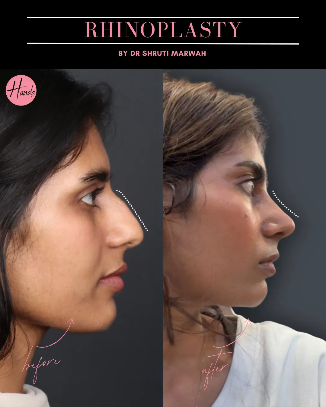 RHINOPLASTY before and after — Handa Aesthetics