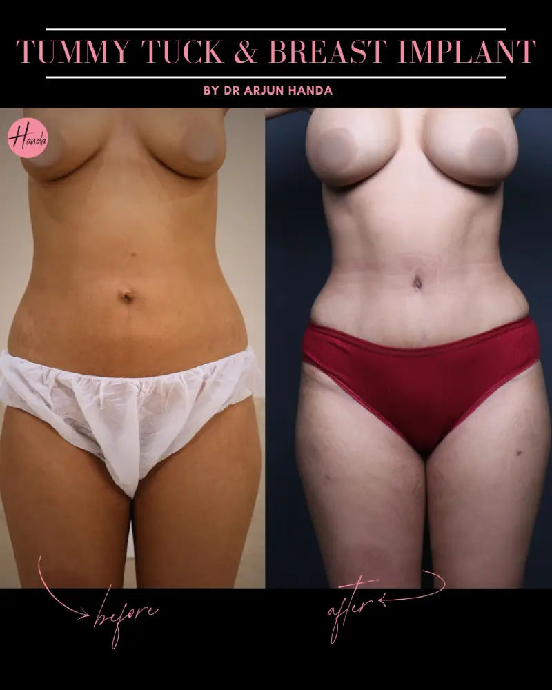 BREAST IMPLANT before and after — Handa Aesthetics