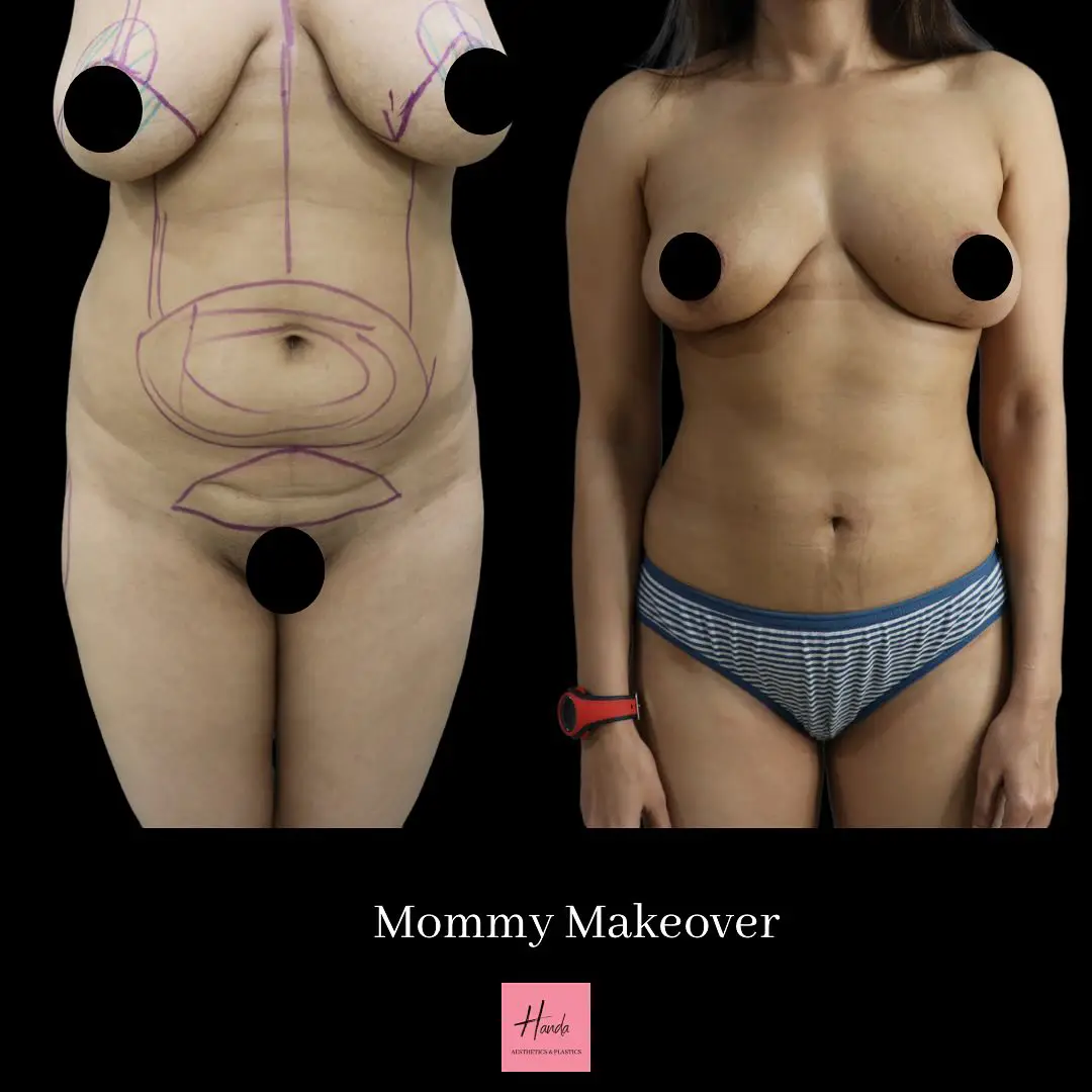 Mommy Makeover before and after — Handa Aesthetics