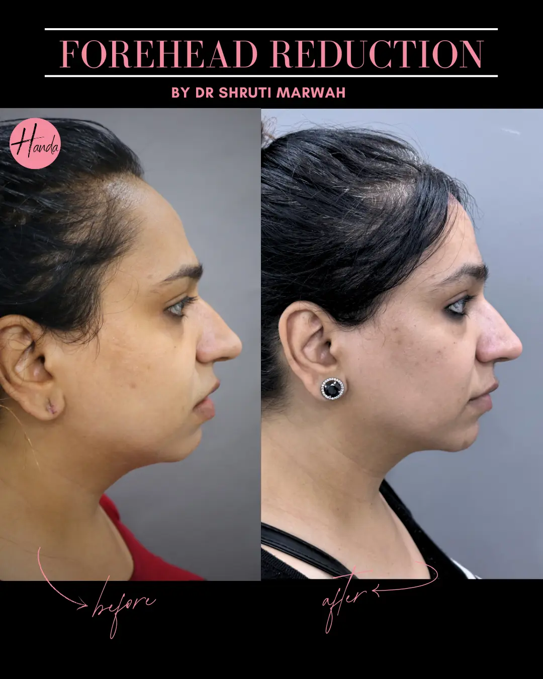 FOREHEAD REDUCTION before and after — Handa Aesthetics