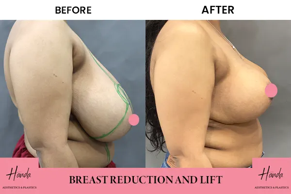 Natural Breast Lift Methods, Breast Lift in Delhi